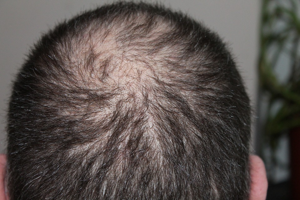 bald man